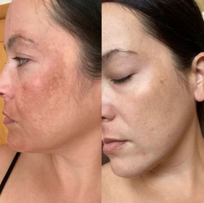 MoreVivo LED Facial Pro