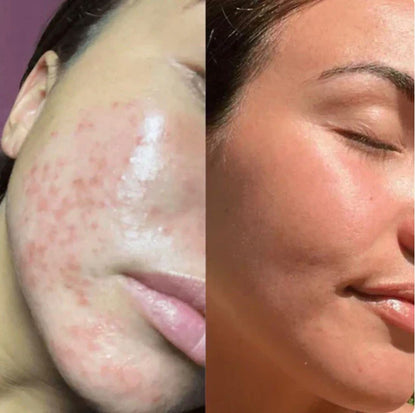 MoreVivo LED Facial Pro
